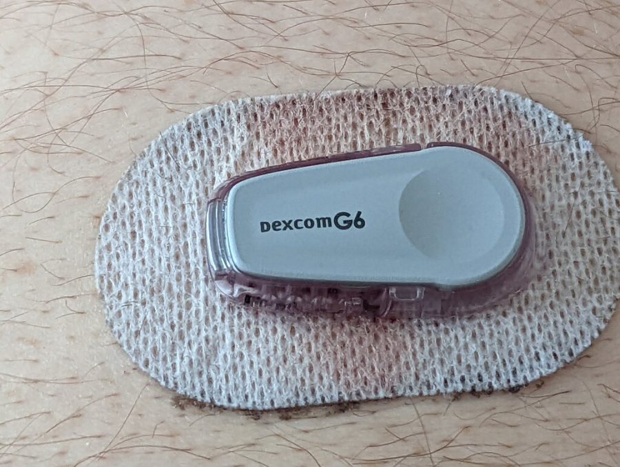 A continuous glucose monitor sensor stuck to the skin with an adhesive patch
